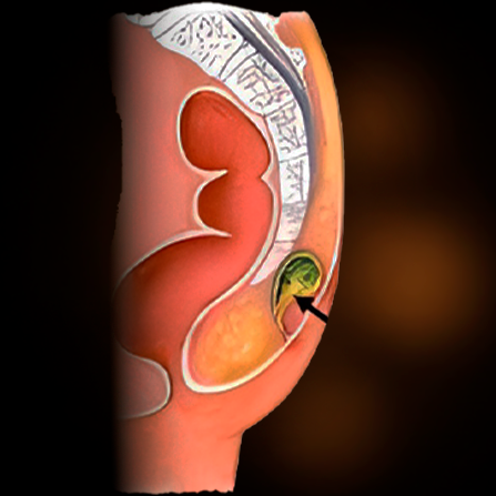 Pilonidal cyst surgery Pilonidal cyst surgery